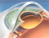 Unfolded ACRYSOF® lens in eye